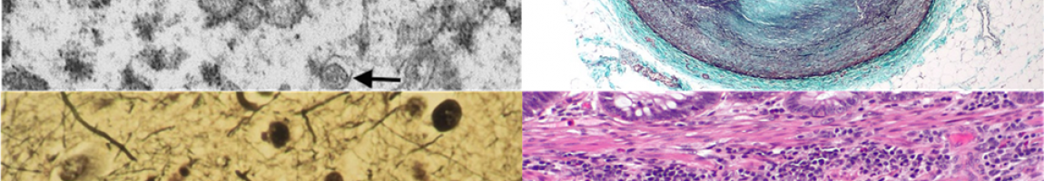 upper left: COVID-19 lung, upper right: atherosclerosis, lower left: Alzheimer’s ameloid paques, lower right: colorectal cancer